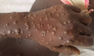 Close em mão apresentando múltiplas lesões cutâneas circulares e elevadas características da Mpox